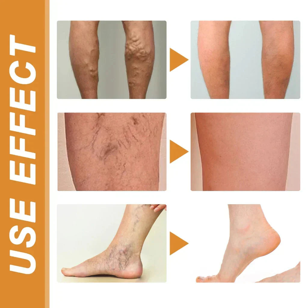 Varicose Veins Spray 鈥� Natural Herbal Formula for Fast Relief