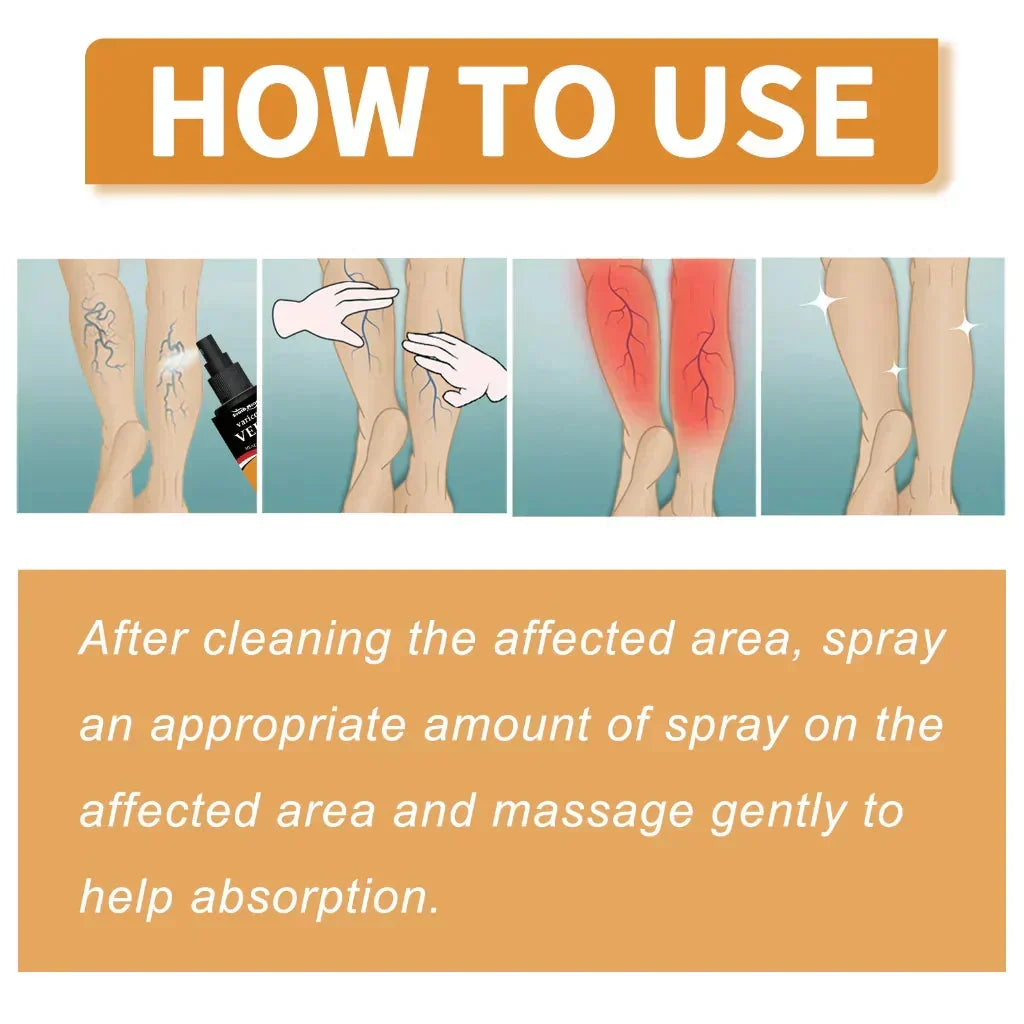 Varicose Veins Spray 鈥� Natural Herbal Formula for Fast Relief