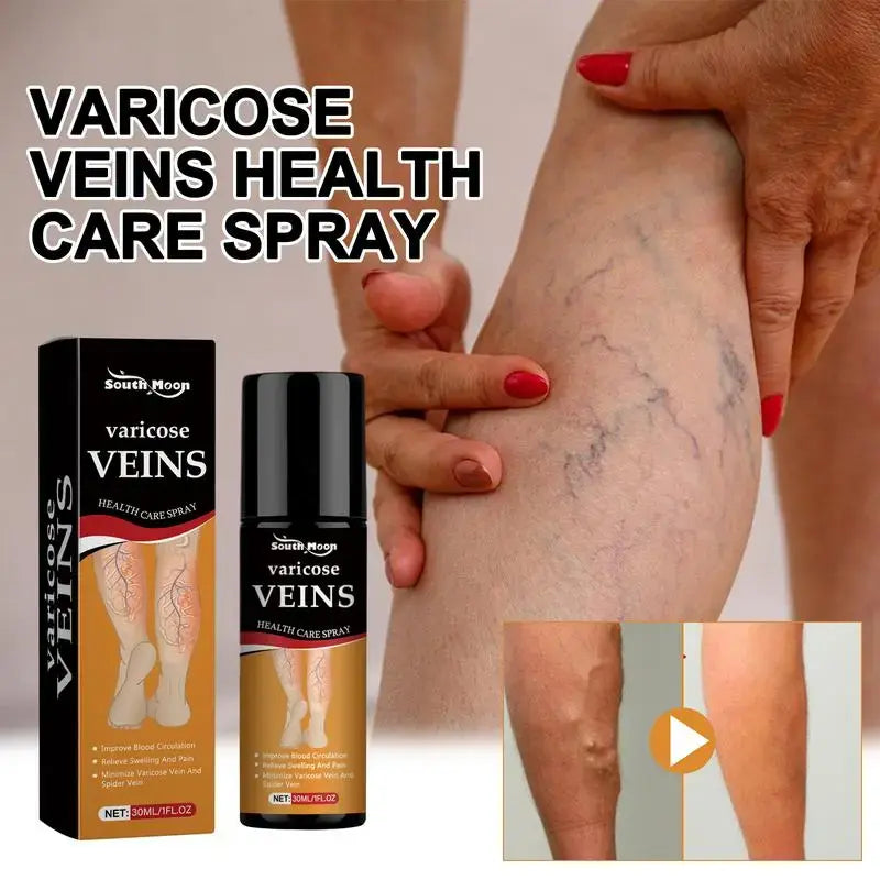 Varicose Veins Spray 鈥� Natural Herbal Formula for Fast Relief